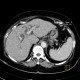 Pseudocyst of pancreas, compression of bile duct: CT - Computed tomography